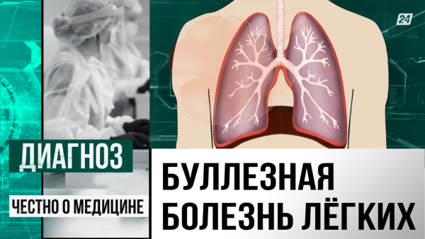 Дышать полной грудью: что такое буллезная эмфизема лёгких и как не умереть от обычного кашля? | Диагноз