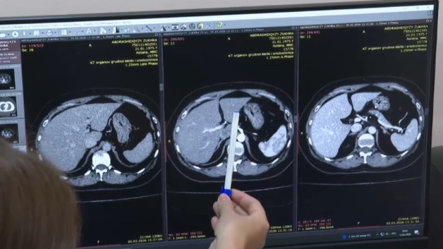 В Казахстане ИИ помогает врачам быстрее выявлять рак и инсульт