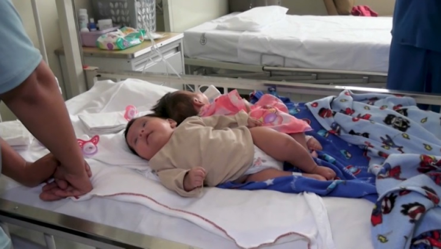 Сиамских близнецов успешно разделили в Перу