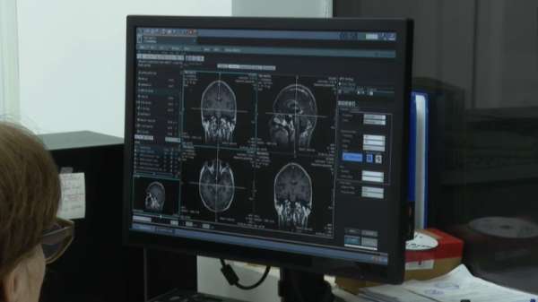 ИИ помог снизить смертность от инсульта на 40% в ряде регионов