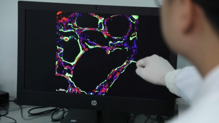 ИИ за минуту диагностирует рак легких с точностью до 90%