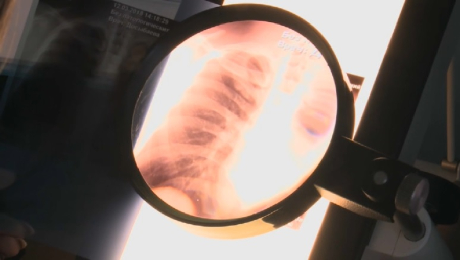 Заболеваемость туберкулезом в Казахстане снизилась на 13,9%