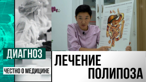 Почему пациентам с полипами сложно поставить точный диагноз в Казахстане? | Диагноз