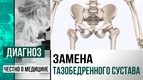 Эндопротезирование тазобедренного сустава: как проводят операцию в Казахстане | Диагноз