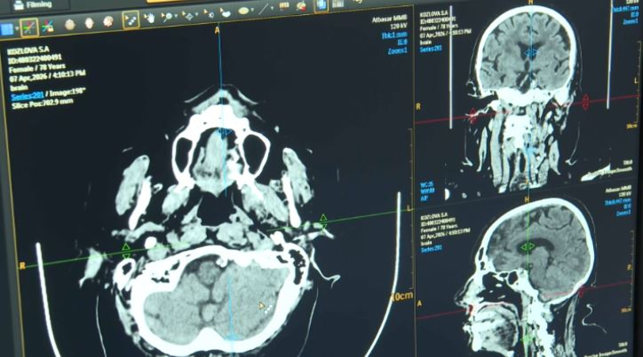 ИИ помогает при диагностике инсульта