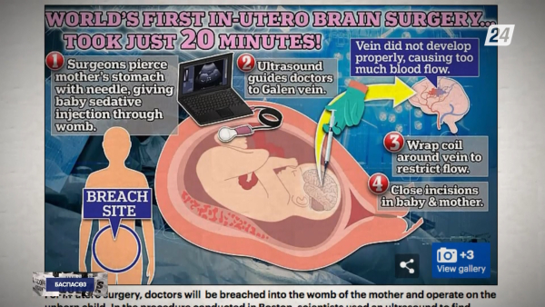 Америкалық дәрігерлер ана құрсағындағы баланың миына операция жасады | Баспасөз