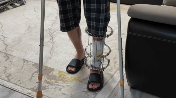 Травма на производстве: будет ли компенсация