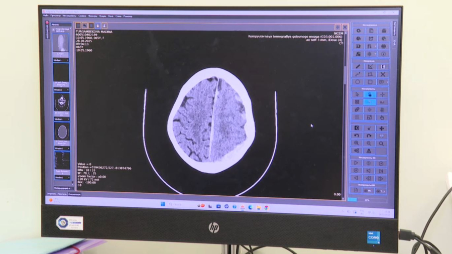 Возраст или образ жизни: инсульт стремительно молодеет