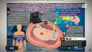 Операцию на мозге ребёнка в утробе матери провели американские врачи | Между строк